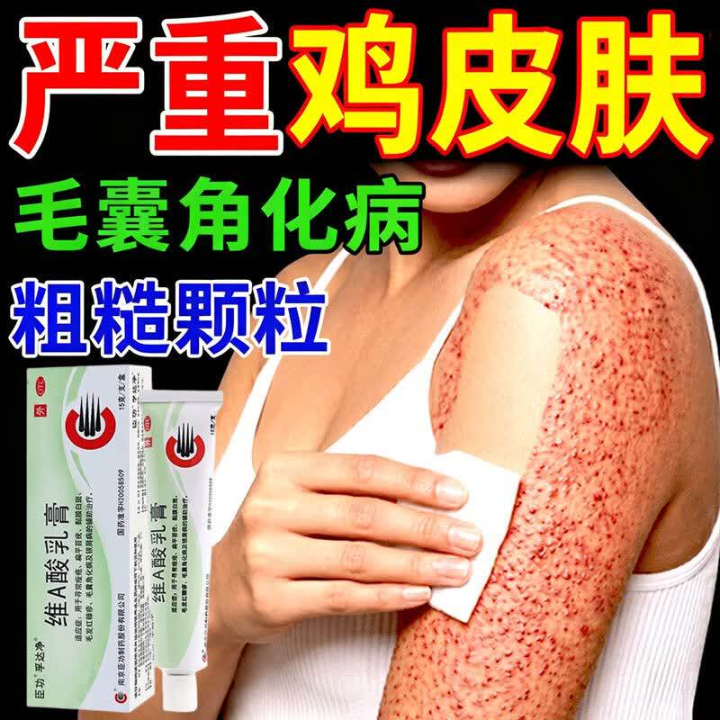 鸡皮肤疙瘩毛囊角化症专用药膏去医用除全身手臂腿维a酸乳膏正品