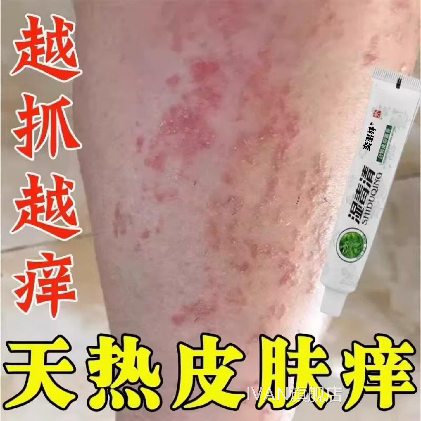 夏天小腿痒湿成人止膏出汗身痒天热皮肤疹上瘙痒热疙瘩红疹热毒痒