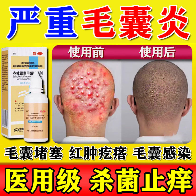 治头皮头部毛囊炎克林霉素磷酸酯外用溶液喷剂角化症专用药除s