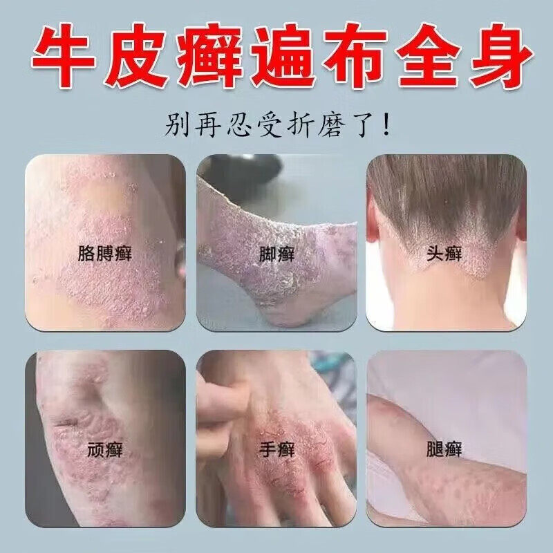 [达克宁]硝酸咪康唑乳膏2%*20g*1支/盒