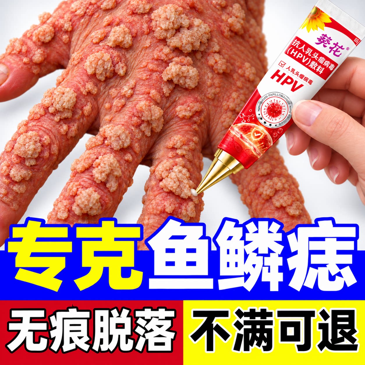 鱼鳞痣膏专门祛肉刺肉疙瘩医用