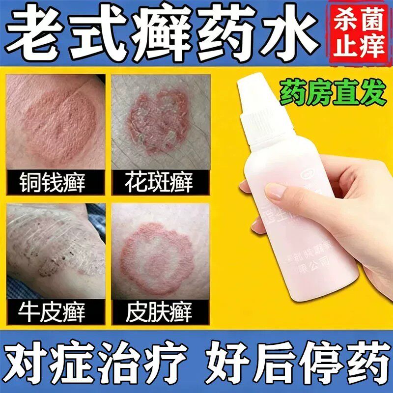 老式癣药水复方土槿皮酊牛皮癣灭丝菌杀菌止痒治藓特新效药水