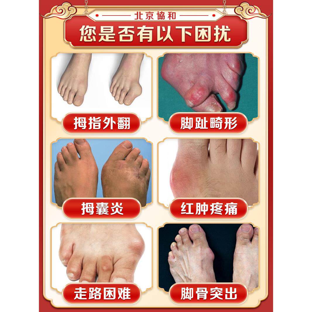 北京协和拇指外翻矫正器大脚趾拇外翻疼痛关节畸形拇囊炎专用贴