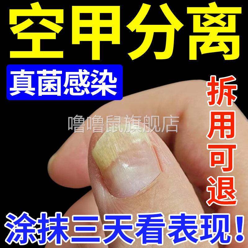 噜噜鼠正品空指甲的甲床分离空甲液可搭配膏药贴真菌感染受损专用