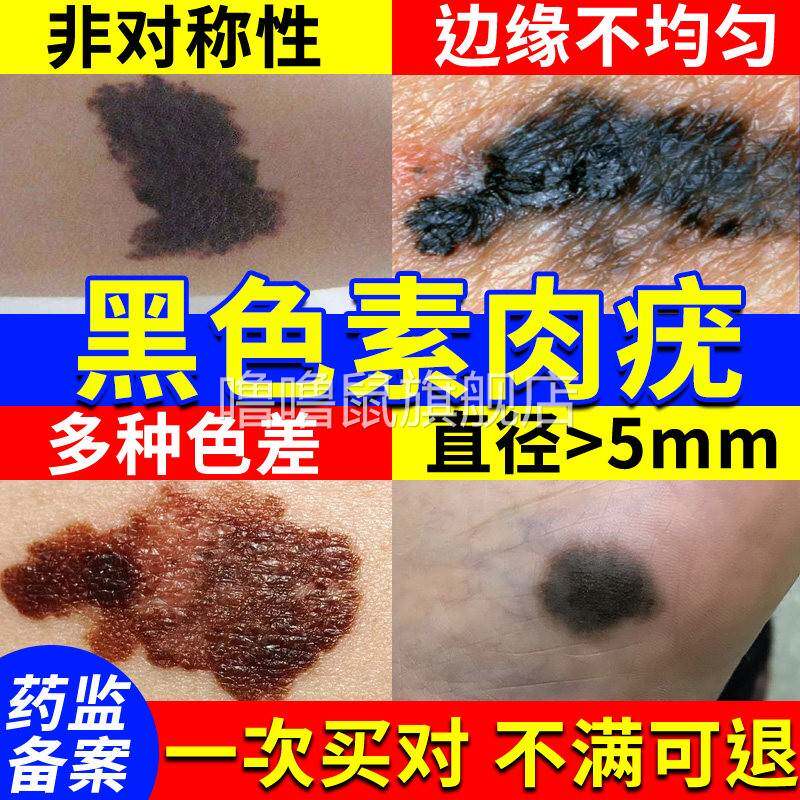 噜噜鼠正品黑色素瘤去祛色素痣除恶变手指足底脚底专用长黑痣可搭