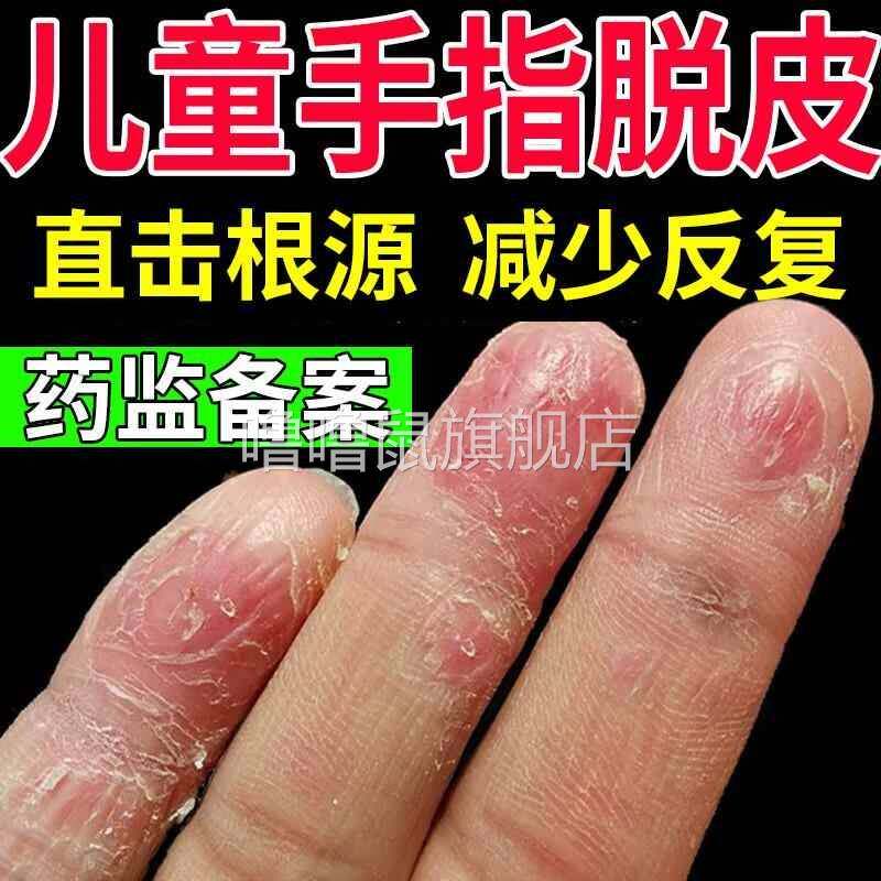 噜噜鼠正品儿童手指头爆脱皮维生素关节手癣膏干裂真菌感染一次特