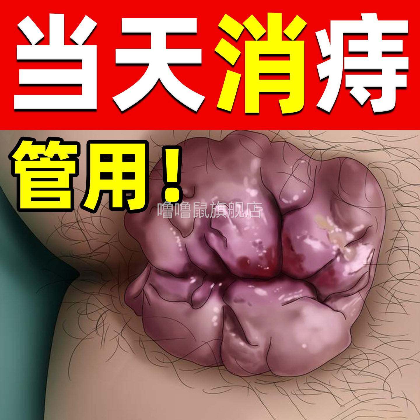噜噜鼠正品痔疮膏凝胶联合致舒男女混合痔内痔外痔敷料便血肛门瘙
