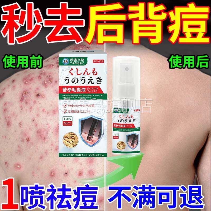 噜噜鼠正品毛囊炎前胸后背头部喷剂马拉色菌毛囊炎真菌感染瘙红肿