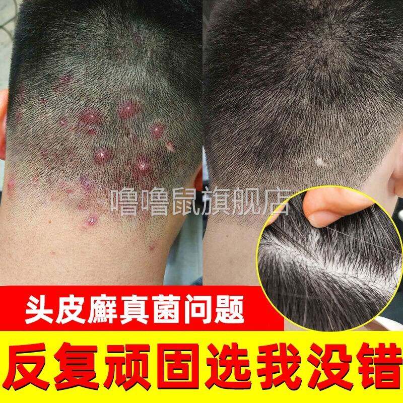 噜噜鼠正品苗疆奇灵真菌星藏苗肤王软膏云南百草膏苗家药膏藏苗肤
