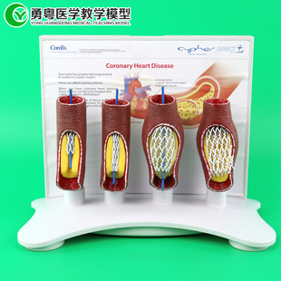 人体血管心脏支架安装过程 心脏搭桥支架安装演示 血管病变堵塞