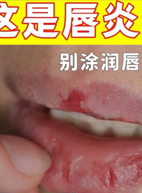 这是唇yan别涂唇膏了！分儿童和成人版本，口角lan也可用