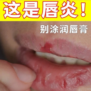 口角lan也可用 本 这是唇yan别涂唇膏了 分儿童和成人版