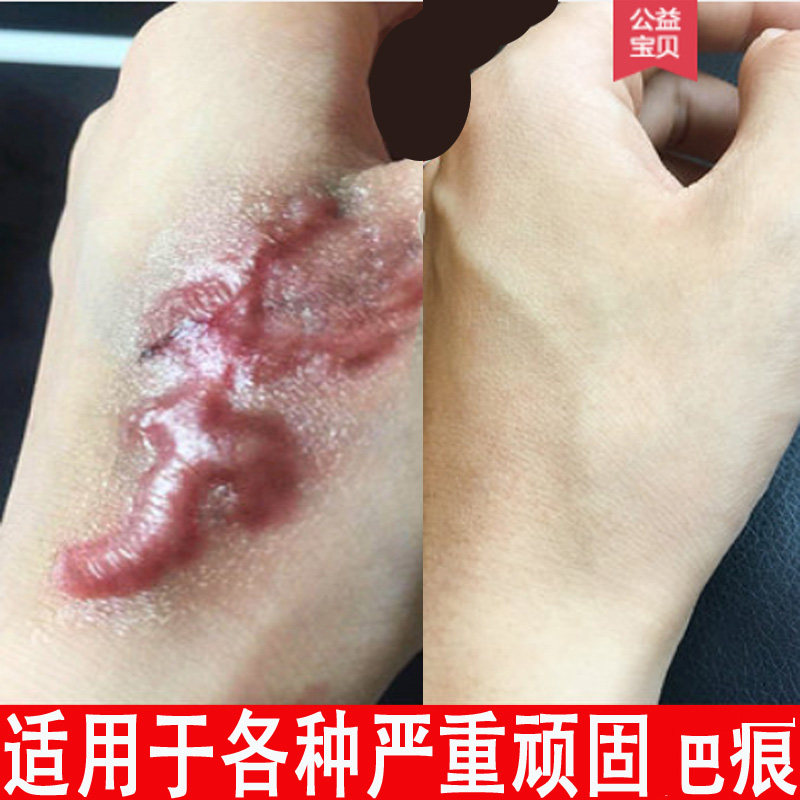 剖腹产疤痕修复除疤膏增生凸起去除疙瘩妊娠纹去烧烫伤手术疤凝胶