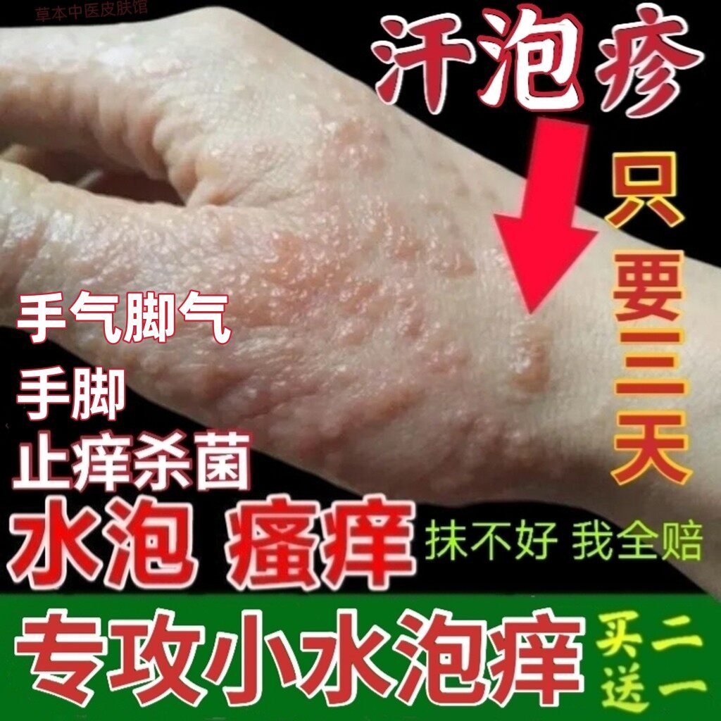 手上长水泡手痒小水泡手指起水泡痒汗疹膏脚手气手足脱皮止痒杀菌
