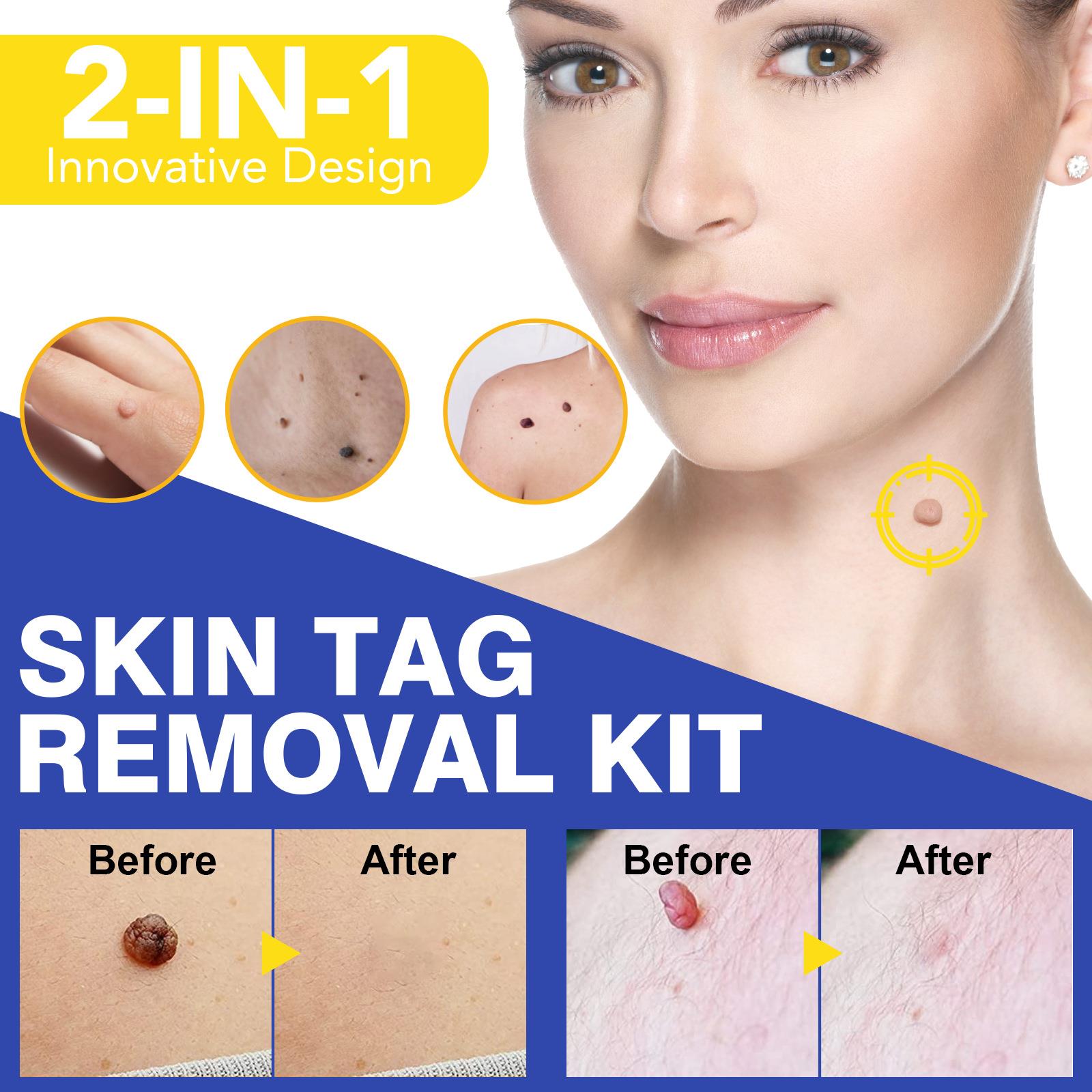 Skin Tag Remover Device for Large Skin Tags祛疣工具平跖去除
