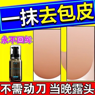 包皮不用割自动脱落修覆收缩矫正器包茎过长隐形阻覆环外翻器