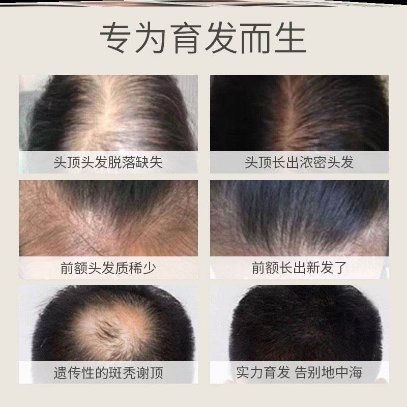 白云山生姜育发液防脱生发排行榜第一名中药姜强根精华发水膏