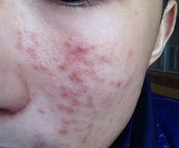 合德医馆 丹参白芨皂后背面部红黑豆印白头闭口男女洗脸手工草本