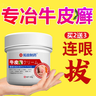 牛皮银屑病外用膏非洗发水药体藓鲜藓专用痒皮肤银屑杀菌正品