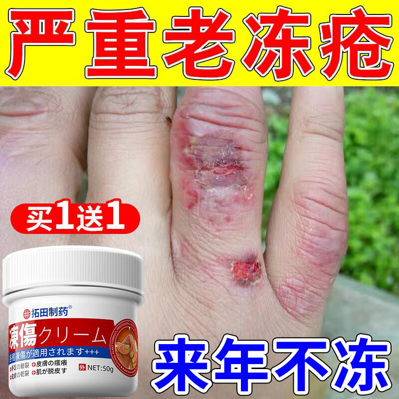 冻疮膏止痒冻伤膏医用正品