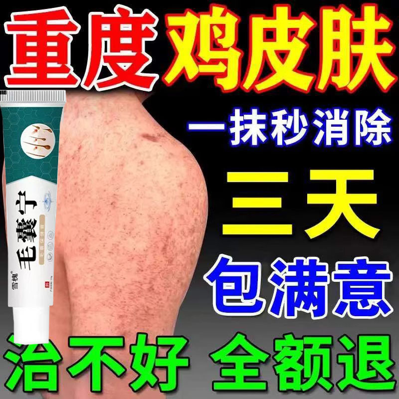 去鸡皮肤疙瘩毛囊角化角质药膏去除全身手臂腿鸡皮疙瘩磨砂乳膏r