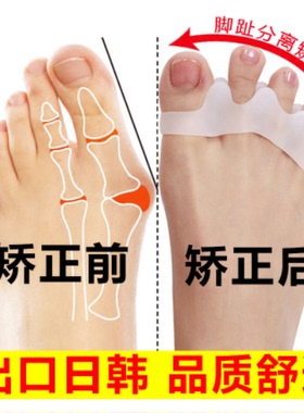 五指大脚骨重叠分趾器