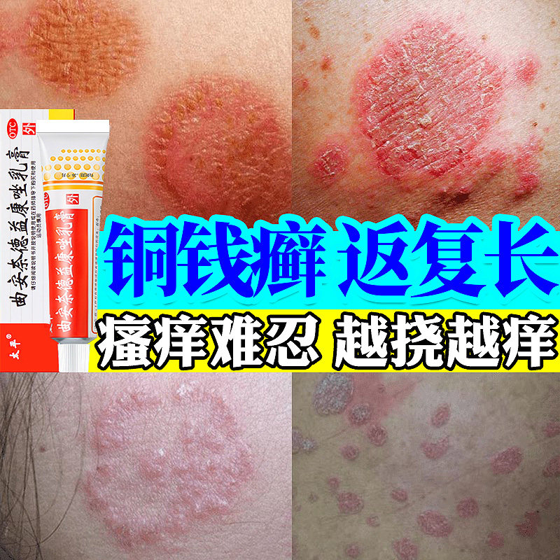 铜钱癣体癣牛皮癣专用药膏皮肤癣痒股癣大腿外用抑菌藓真菌感染NN