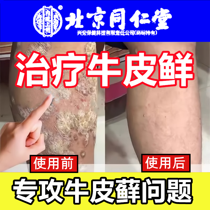 治疗顽固牛皮癣银屑病真菌感染汗斑花斑癣专用药膏牛皮藓中药ty