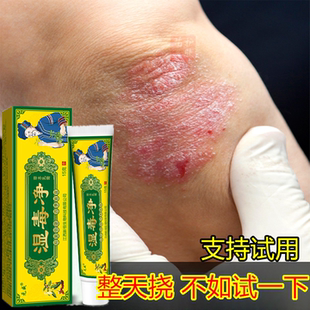 湿毒净皮肤快速止去痒膏男女大腿内侧搔痒手足头皮藓顽固藓痒乳膏