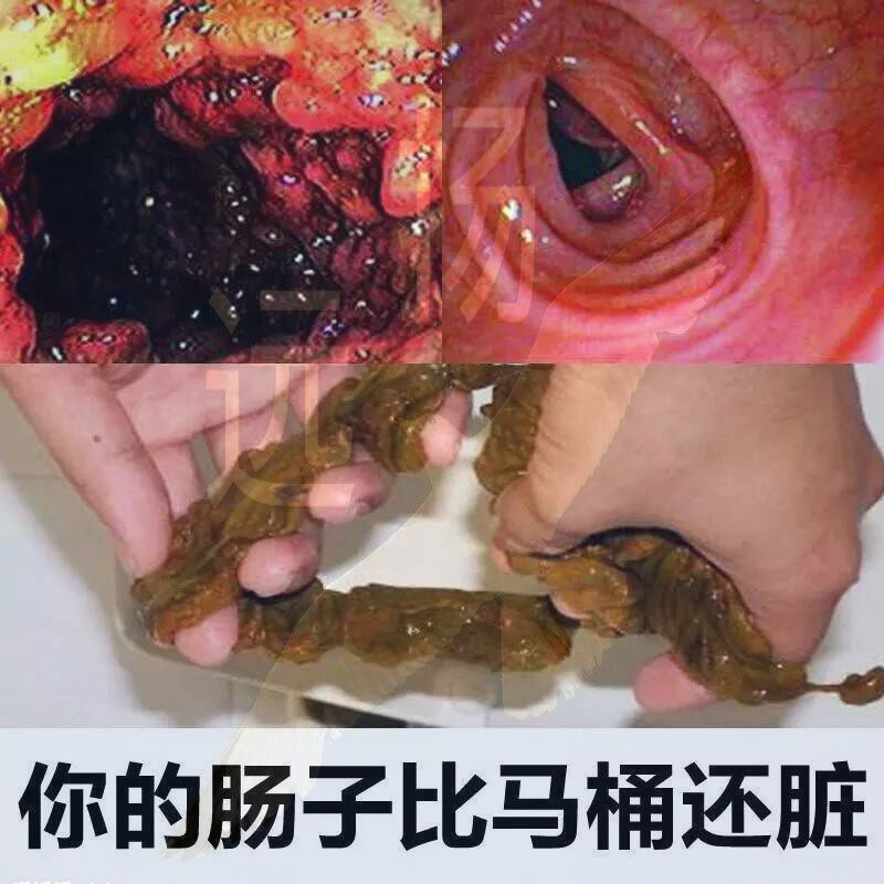 藤黄果同款肠排肠垢清宿便综合果蔬酵素粉水果酵素灌肠线下实体款