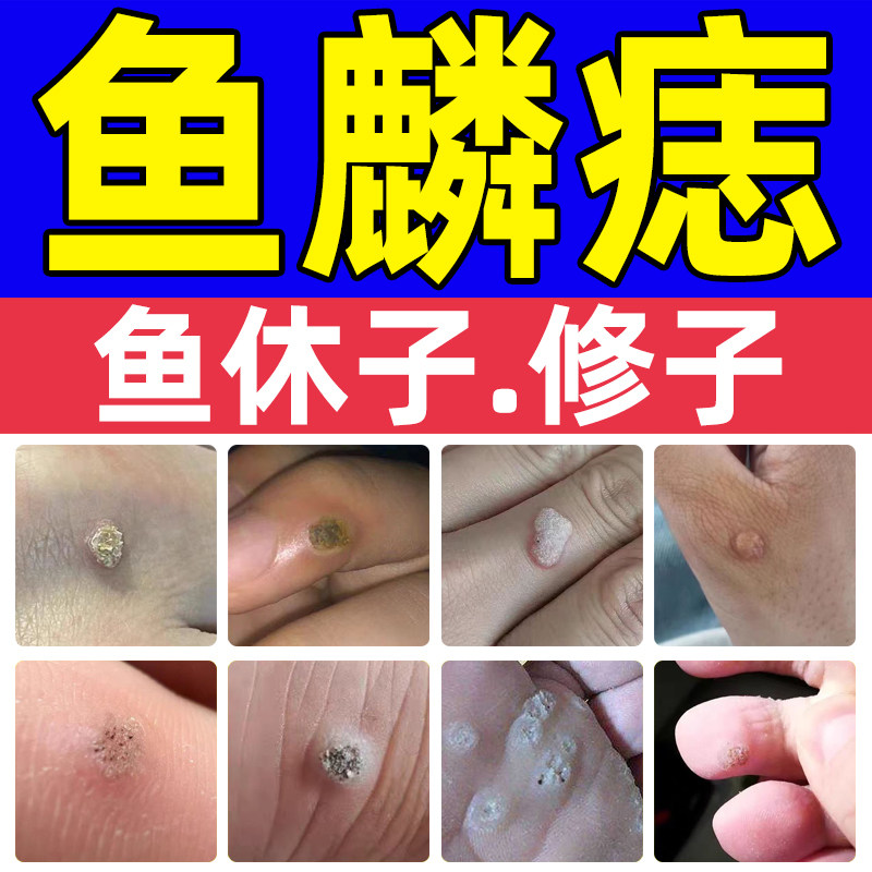 去鱼鳞痣贴血胞刺老鼠痣手上脚上取鱼休子羞修子非药水专用去除膏
