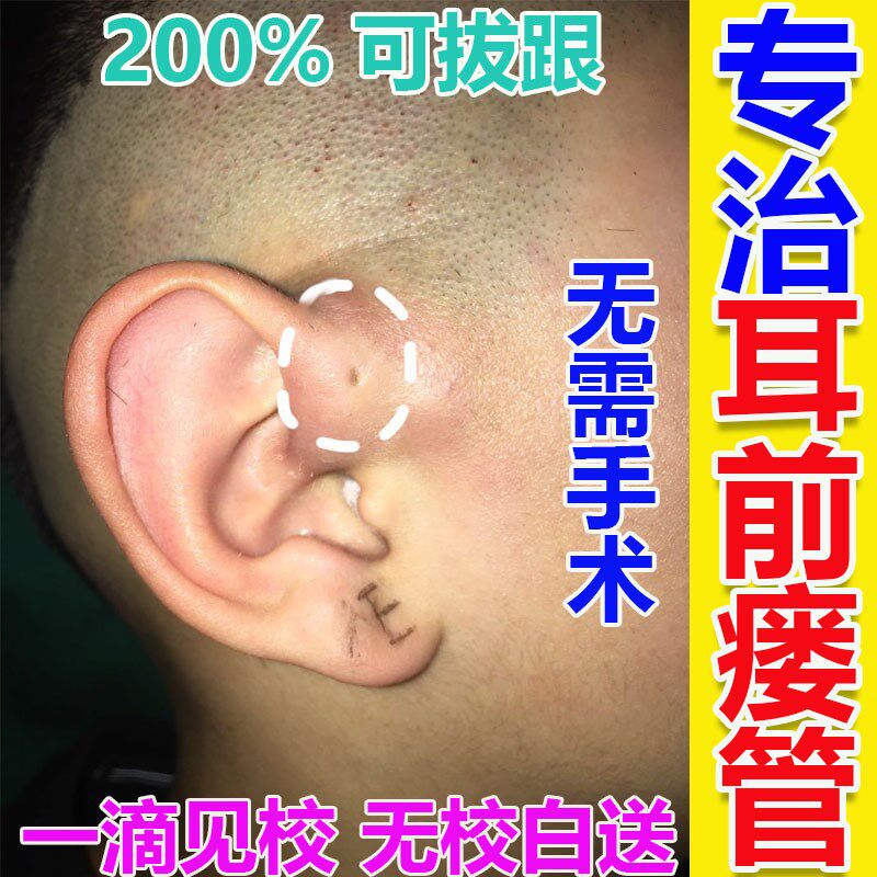 治疗耳前瘘管药膏耳仓发炎流脓红肿疼痛鼓包异味中耳炎专用滴耳液
