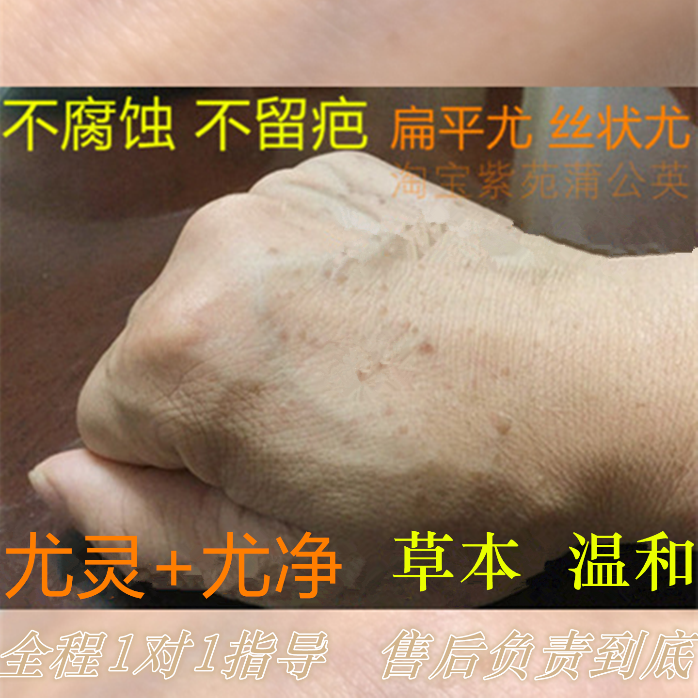 儿童扁平疣去除不腐蚀不留疤 大人面部身上草本祛疣灵 温和不留疤