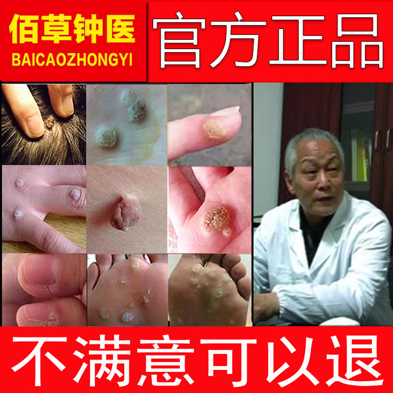 去除肉刺猴子肉粒手足部正品