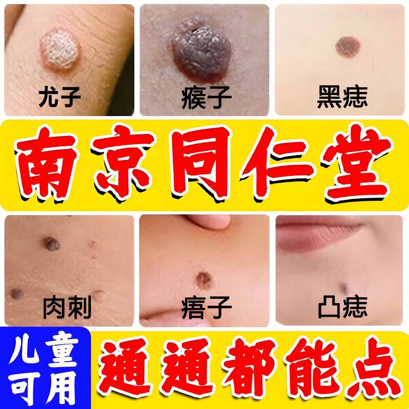 点痣膏无痕正品官方旗舰店脸部去淡非药水点斑水祛痣笔专用膏液除