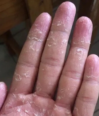 手脱皮修复霜季节性手掌手指头蜕皮开裂干裂维生素褪起皮掉皮爆