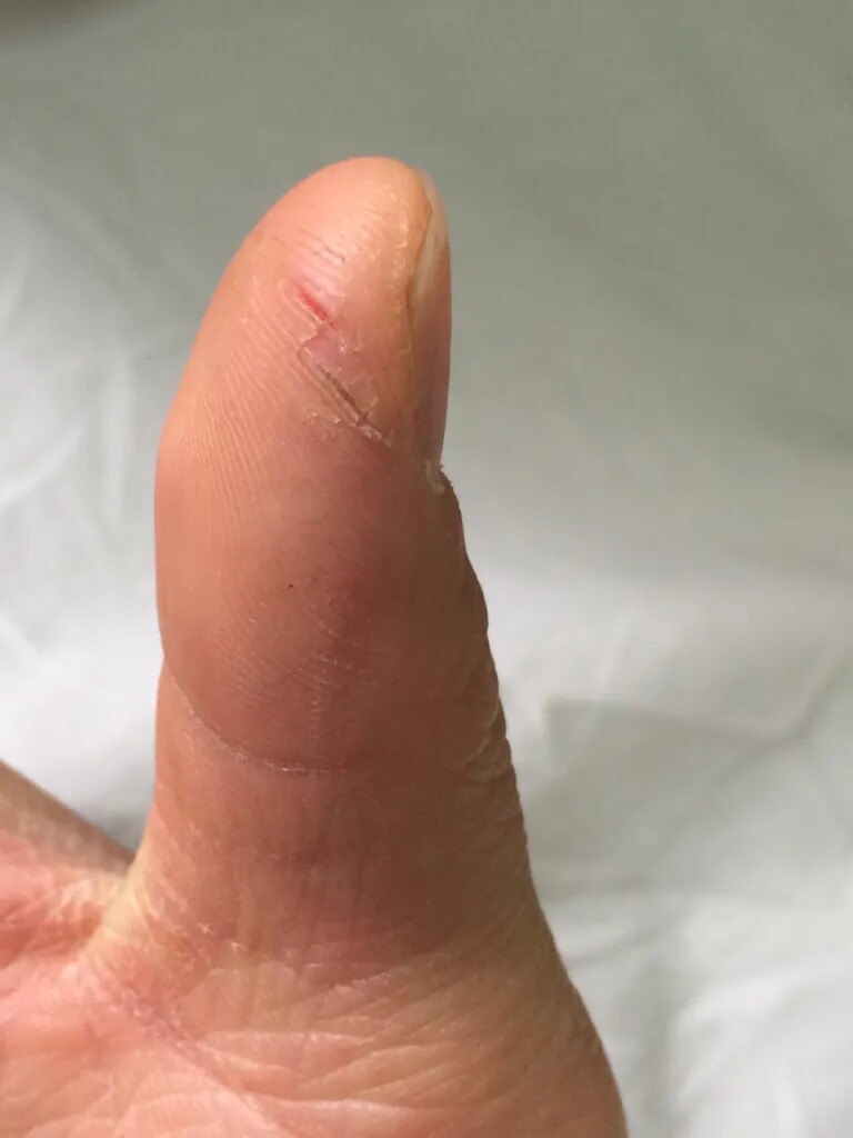 2024摸摸恢复,一抹恢复手脱皮,手掌开裂,手干裂粗糙起皮蜕皮