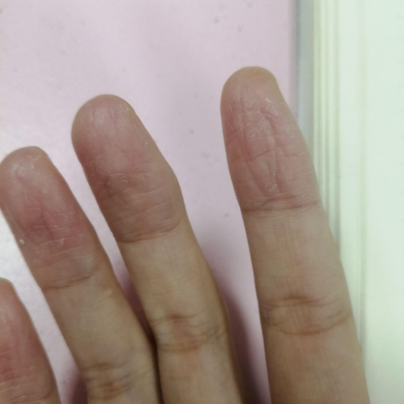 手足脱皮开裂护肤膏手脚粗糙干燥蜕皮手掌起皮止痒外用滋润修复膏