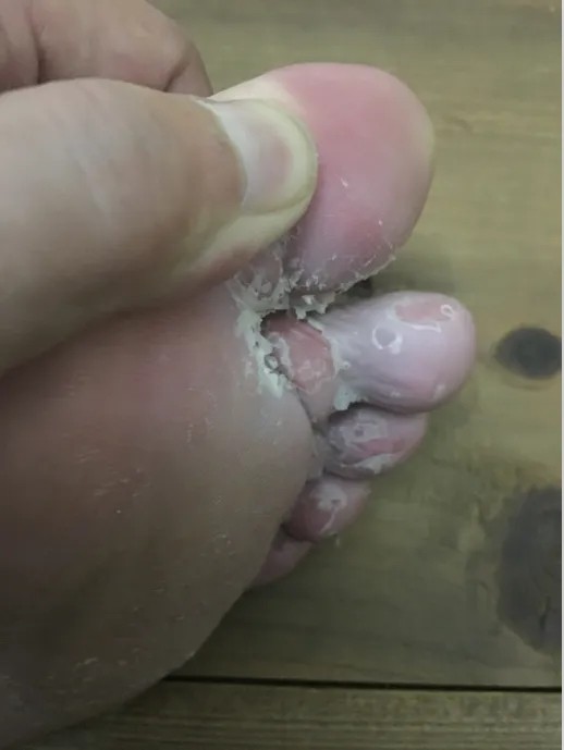 烂手丫丫干裂皮肤瘙痒足部