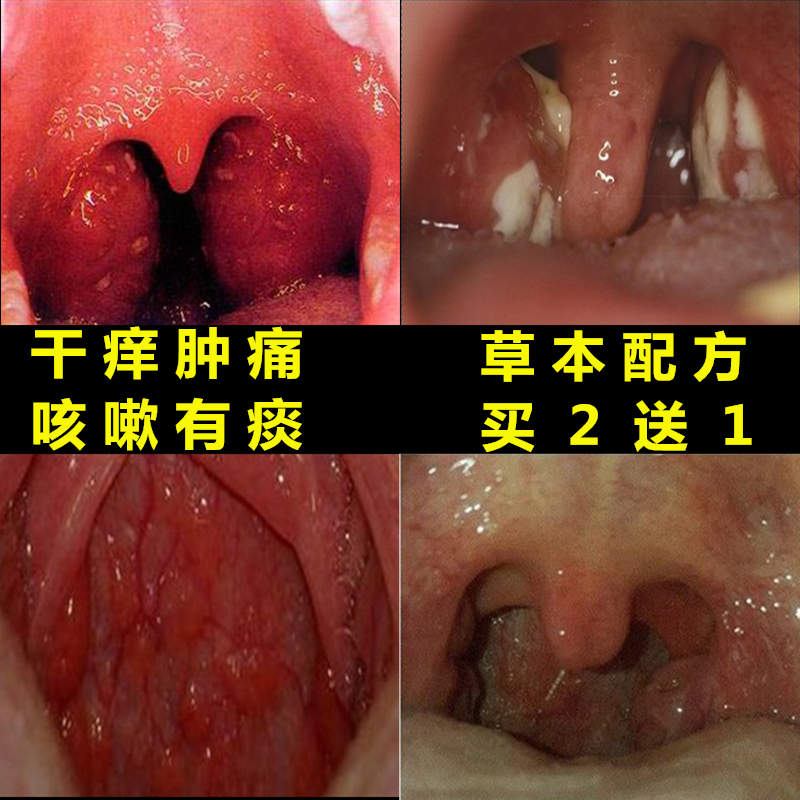 扁桃体发炎肥大肿大 喉咙干痒咳嗽咽喉肿痛喷雾 喉咙