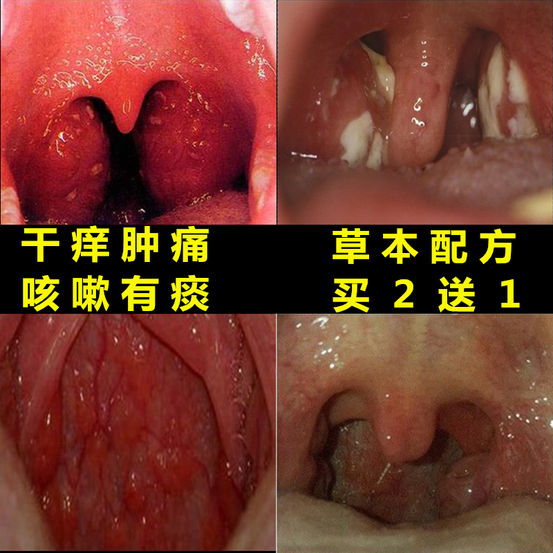 扁桃体发炎肿大喉咙咽喉异物感