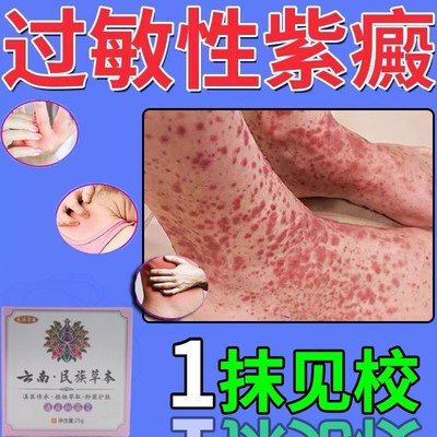 治疗过敏色素性紫癜特效药皮炎皮肤病药膏皮下出血红点血管炎专用