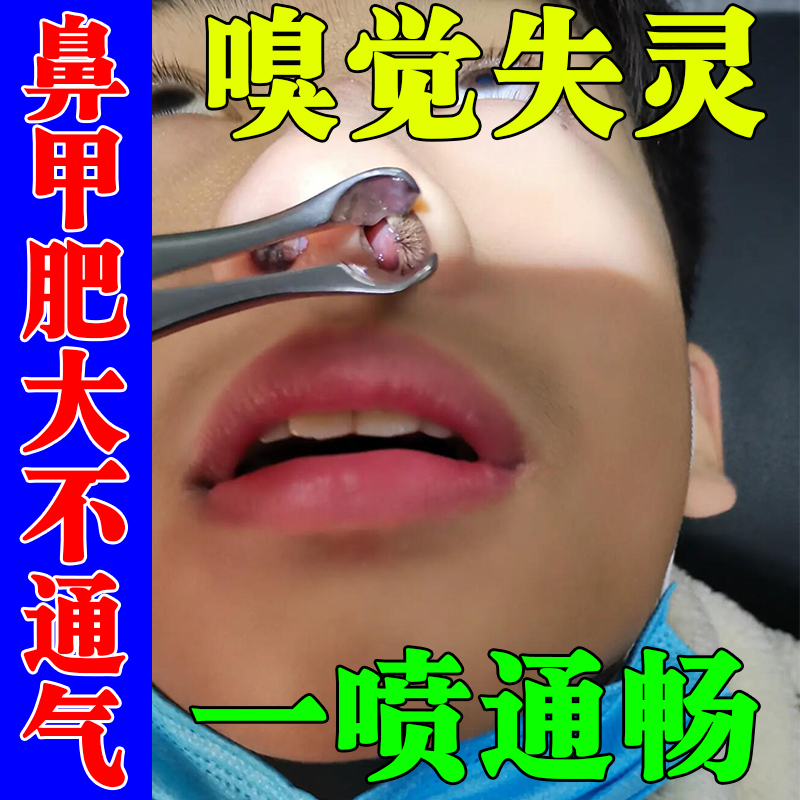 鼻子不通气神器鼻涕倒流喉咙有痰鼻腔堵塞过敏性炎鼻鼻塞鼻甲肥大