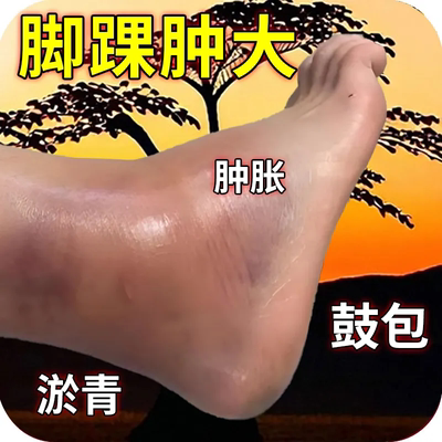 脚踝肿大疼痛专用药骨裂陈旧老伤关节肿大活血化瘀韧带拉伤药膏