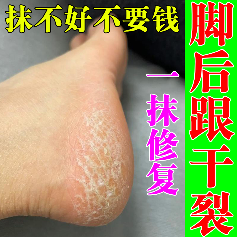 脚后跟干裂起硬皮足跟开裂真菌感染鳞屑角化型脚脱皮去死皮药专用