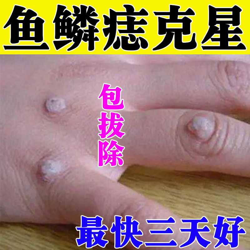 鱼鳞痣点痣药肉粒肉疙瘩手指头手皮肤消毒护理（消）