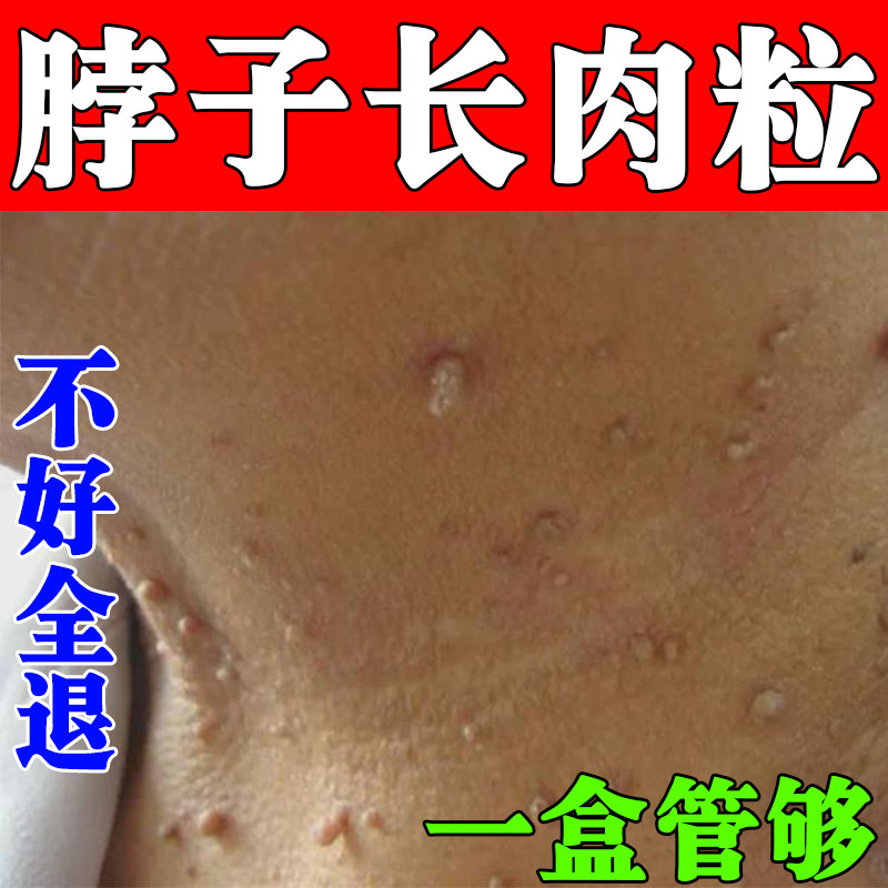 治脖子上的小肉粒疙瘩猴子丝状尤皮肤消毒护理（消）