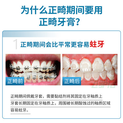 日本狮王正畸牙膏矫正专用成人戴牙套防蛀含氟牙齿龋带牙蛀牙正崎