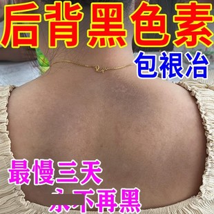 【当天去除】后背黑色素沉淀祛痘印淡化色素沉着美白背专用药膏