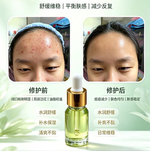 美容院专用去痘精华原液修护暗沉粉刺淡化痘印痘坑收缩毛孔 OEM